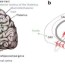 deep brain stimulation for epilepsy