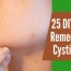 25 cystic acne home remedies that