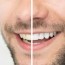 at home products vs professional teeth