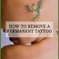 clean slate laser tattoo removal