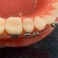 broken brackets what you need to know