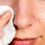 natural remedies for blackheads you can