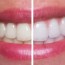 diy teeth whitening trends