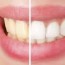 teeth whitening diy is it a good or