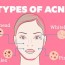 9 best overnight home remedies for acne