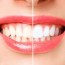 professional teeth whitening vs diy