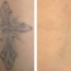 tattoo removal how to costs before