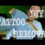 tscs diy tattoo removal