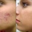 diy acne scar treatment for stubborn